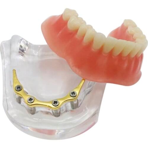 1pcs Dental Implant Restoration Model With Golden Metal Rod 4 Planting Nails Student Learning Teaching Model