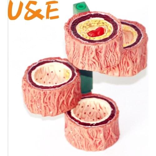 Human Atherosclerosis Model Thrombosis Model Artery Model Thrombosis Evolution Anatomy Medical Teaching Tool
