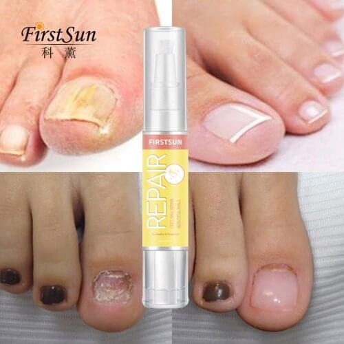 Fungal Nail Treatment Essence Nail and Foot Whitening Toe Nail Fungus Removal Feet Care Nail Gel Makeup Set Tool