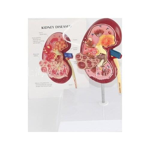 Kidney disease model urology kidney nephron renal glomerulus kidney anatomical model free shipping