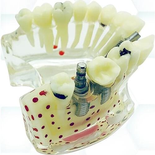 Dental Model Implant Model Dental Disease Teaching Study Demonstration Model Dentistry Products