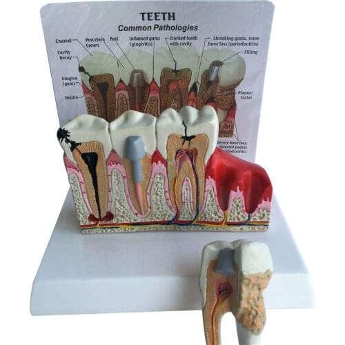 1pcs Dental Tooth Teeth Anatomical Model Dental Anatomy Teeth Model Oversized Anatomy