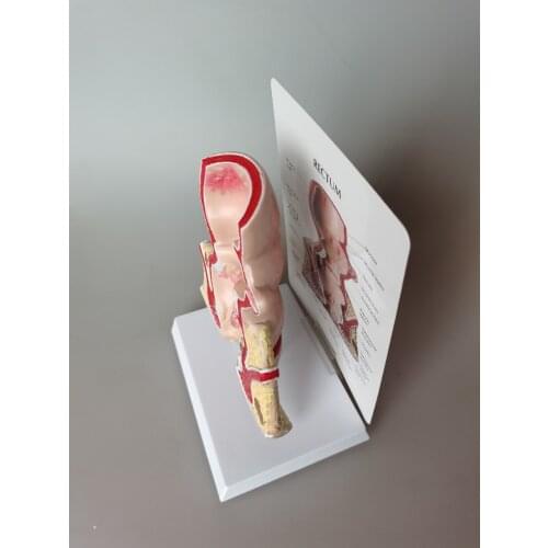 Pathological hemorrhoid model