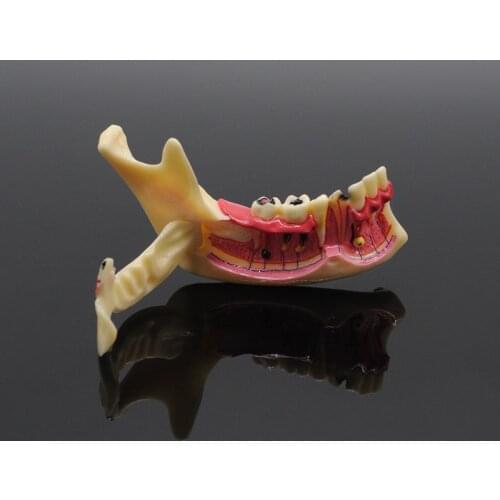 Dental Mandibular Teeth Model Dentures Communication Model Dental Teaching Training Dentistry Model