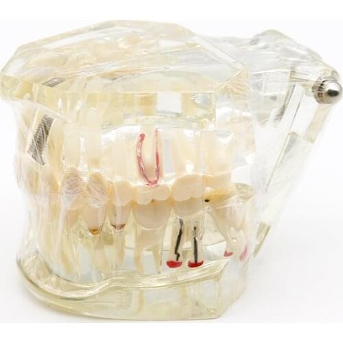 Dental Restoration Teeth Model Transparent Implant Disease Teeth Model with Bridge Detachable Teeth Disease Teaching Study Model