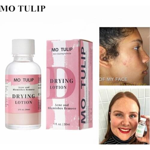 MO TULIP 30ml effective Acne Treatment Face serum Mario Badescu Drying Lotion Anti Acne Serum Pimple Blemish Removal