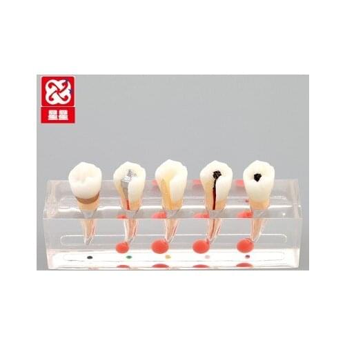 Tooth The roots Treatment Model Dental teaching model free shipping