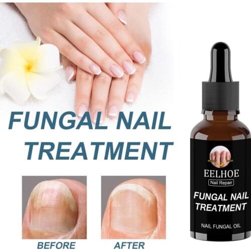 Fungal Nail Repair Serum Nail Care Onychomycosis Repair Liquid Treatments Foot Nail Fungus Removal Promote Healthy Nail Growth