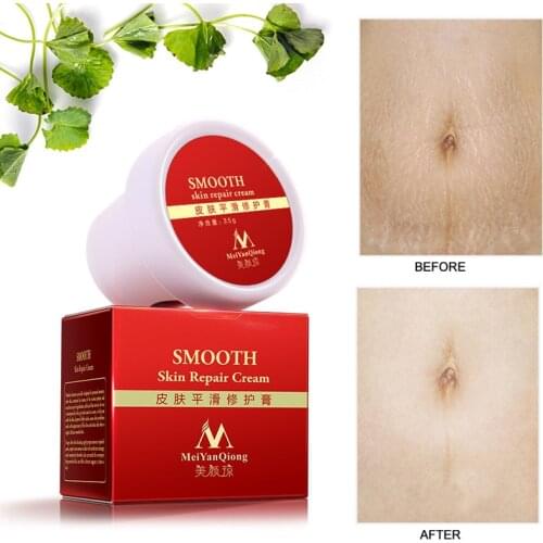 MeiYanQiong Precious Skin Body Smooth skin Cream Stretch Marks Remover And Scar Removal Postpartum Obesity Pregnancy Face Cream