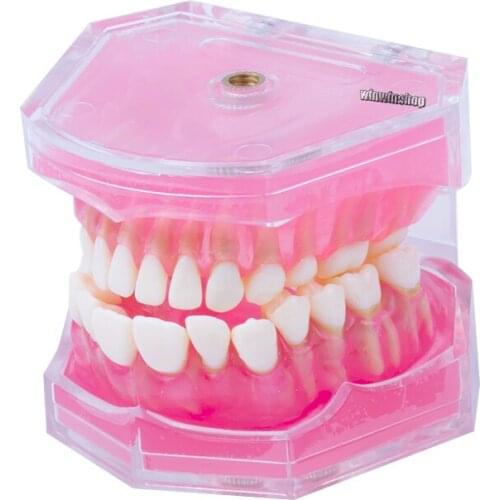 1 PC Dental Implant Disease Teeth Model With Restoration Bridge Tooth Dentist For Medical Science Dental Disease Teaching Study