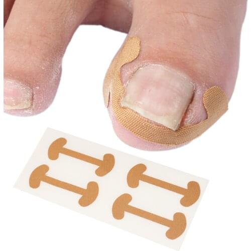 20pcs Professional Embedded Toe Nail Corrector Sticker Toenail Care Pedicure Thumb Curl Correction Sticker