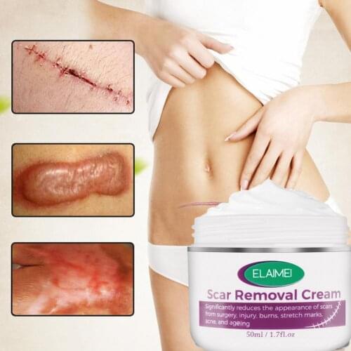 50ml Scar Cream Scar Removal Cream Acne Scars Gel Stretch Marks Fade Scars Skin Care Scar Skin Stretch Mark Treatment Body Part