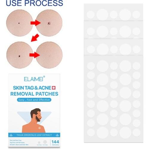 144pcs Medical Skin Tag Kill Skin Mole Wart Remover Micro Band Skin Tag Removal Kit With Cleansing Swabs Adult Mole Wart Face