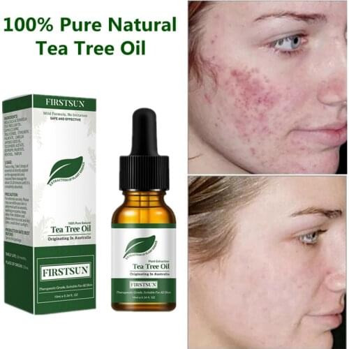 LANTHOME Acne Treatment Face Serum Tea Tree Fades Acne Marks Remover Scar Shrink Pores Whitening Moisturizing Facial Essence Oil