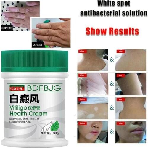 30ml Sumifun Chinese Vitiligo Ointment For Daytime Of Cream Hands Treatment Symptoms Face Liniment On Neck Back F6J9