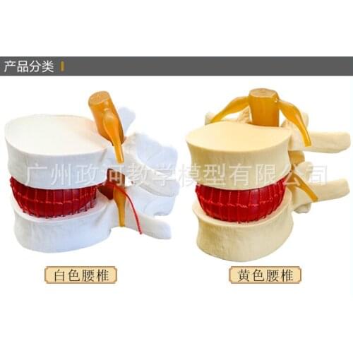1.5 Times Life Size Human Lumbar Disc Herniation Demonstration Model Lumbar Model Spine Model Biology Medical Skeleton Toy
