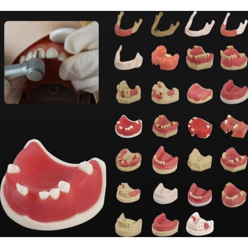 Good quality Mandibular model dental patient communication implant model dentures teeth model for dentists learning