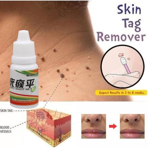 Black Dots Mole Wart Skin Tag Remover 12 Hours Tu Kill Liquid Medical Foot Corn Removal Foot Care Mole Skin Tag Removal Solution