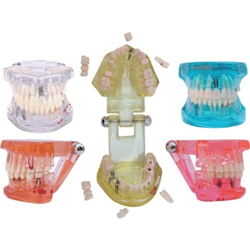Pathology Implant Model Cear Primary Teeth Model Clear Extraction Caries Model 4 Times Periodontal 6 Times Anatomy Teeth Model