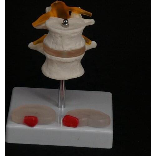 Human Two Lumbar Lesions Intervertebral Disc Skeleton Spine Model Medical Teach