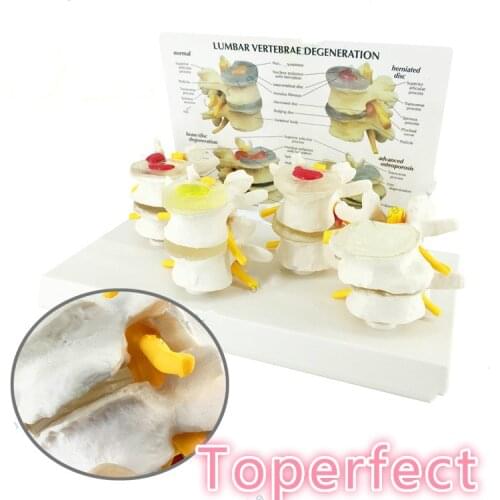 Medical Normal Lumbar Spine Lesion Combined Anatomical Model Intervertebral Disc Pain Teaching Skeletal Model