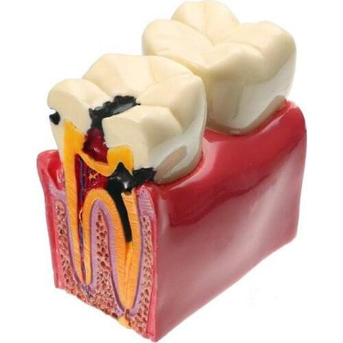 Dental Materials Lab Learning Teeth Model 6 Times Caries Comparation Study Simulation Models