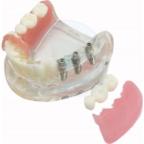 1pcs Dental Mandible 3 Nails Implant Overdenture Teeth Model with Micro planting Teeth Model