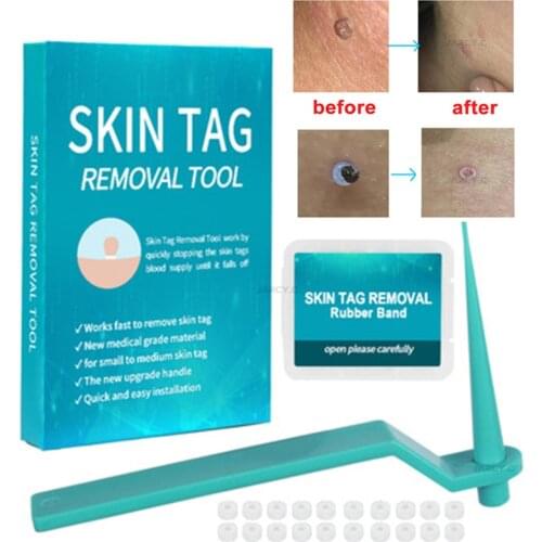 Micro Band Tag Removal Kit Papillomas Treatment Face Care Mole Wart Tool Cleaning with Skin Tag Removal Rubber Ring Home Use
