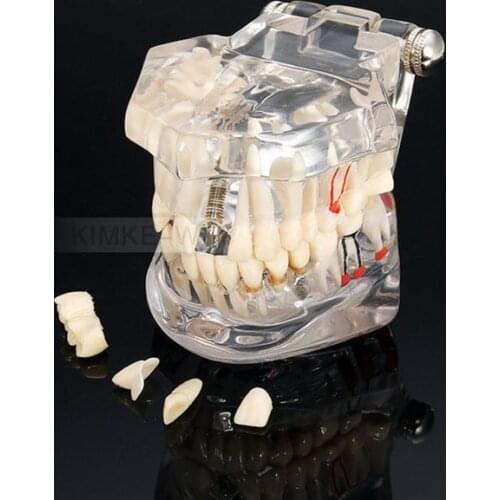 2016 New Removable Dental Implant Disease Teaching Teeth Model & Restoration Bridge Tooth