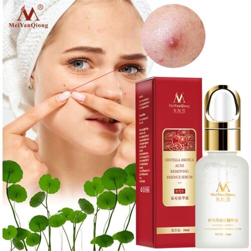 Acne Treatment Face Serum Centella Asiatica Oil Control Shrink Pores Scar Anti Acne Essence Whitening Moisturizer Skin Care 10ml