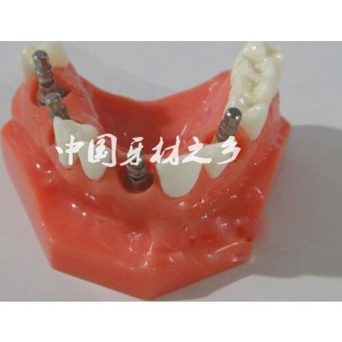 Continental implant tooth model with Planting nail teaching appliance free shipping
