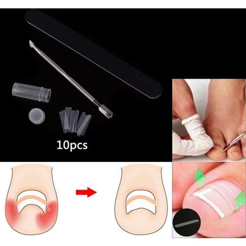 1 Set Toenail Straightening Clip Curved Brace Toe Nail Ingrown Toenail Patch Pusher Recover Straightening Clip Foot Care Tool