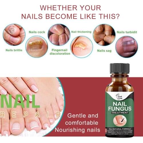 Toe Fungal Nail Essence Treatment Anti Fungal Repair Gel Onychomycosis Anti-Fungal Nail Infection Herbal Toe Fungus Foot Repair