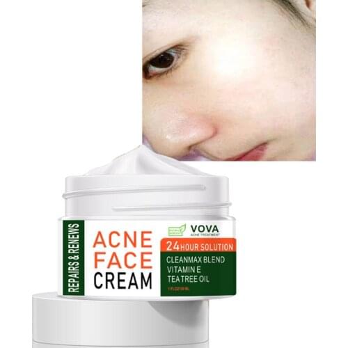 30ml Acne Cream Moisturizing Acne Cream Acne Scars and Acne Facial Repair