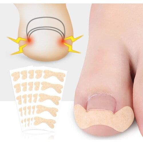 Ingrown Toenail Corrector Sticker Toe Inlay Nail Corrector Nail Patch Paronychia Treatment Recover Corrector Correction Stickers