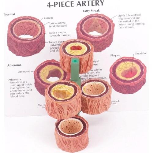 4-Stage Cross Section Human Artery Anatomical Vascular Occlusion Model Medical Learning Kit Teaching Resources