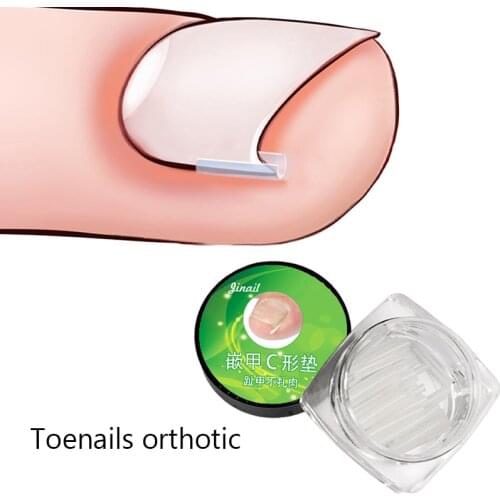 Ingrown toenail 10pcs/set Ingrown Nail Pad Ortho Nail Filling Nail Groove Pad Ingrown Nail Corrector Ingrown Nail Artifact