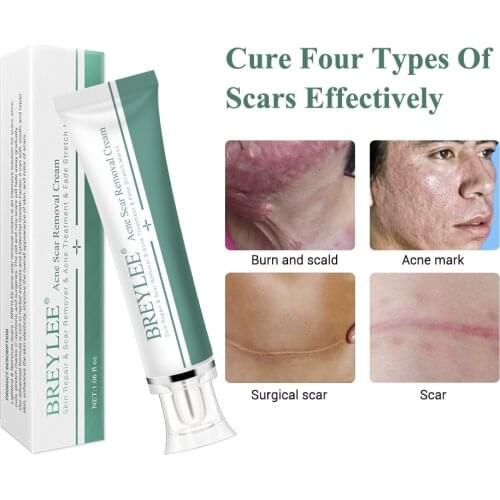 Skin Scar Acne Mark Removal Ointment Acne Maternity Postpartum Treatment Stretch Marks Scar smooth Repair Skin Care Cream
