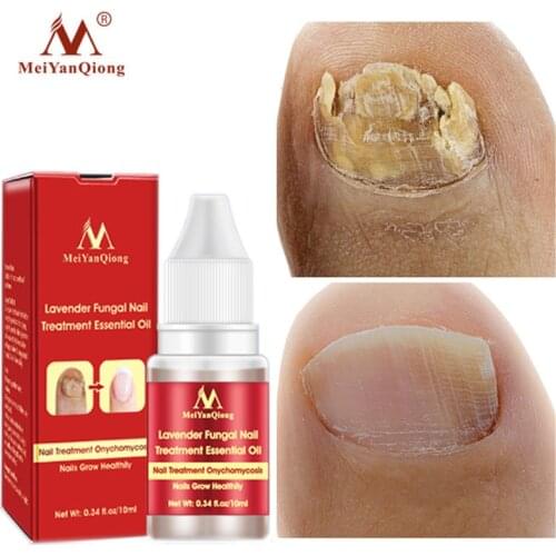 Fungus Nail Treatment Essence Repair Serum Foot Nail Fungus Removal Gel Anti Infection Paronychia Onychomycosis Toe Care 10ml