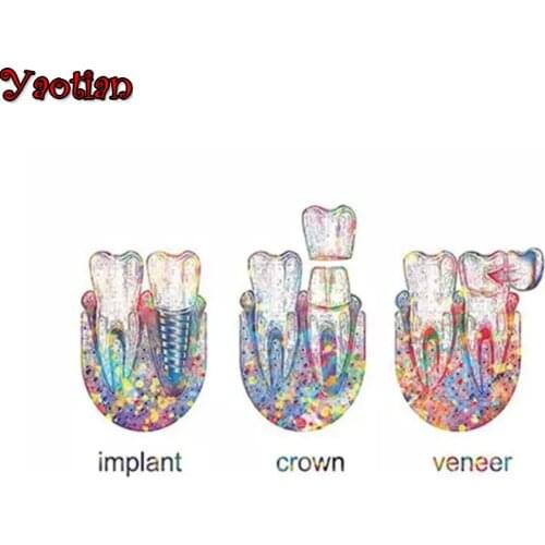 Diamond Painting Dental Implant Art Dentistry Gift Diamond Embroidery 5D Mosaic Diamond Needlework Cross Stitch Puzzle Art Decor