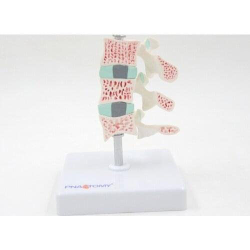 Osteoporosis Model Rarefaction of Bone Loss Lumbar Anatomical Model Medical Demonstration Educational Equipment Teaching Tool