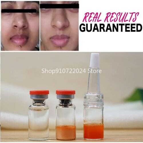 3ml 1 pair Remove Darkness Around Mouth and Chin Whitening Dark Spot Freckles More 100% Effective Free shipping
