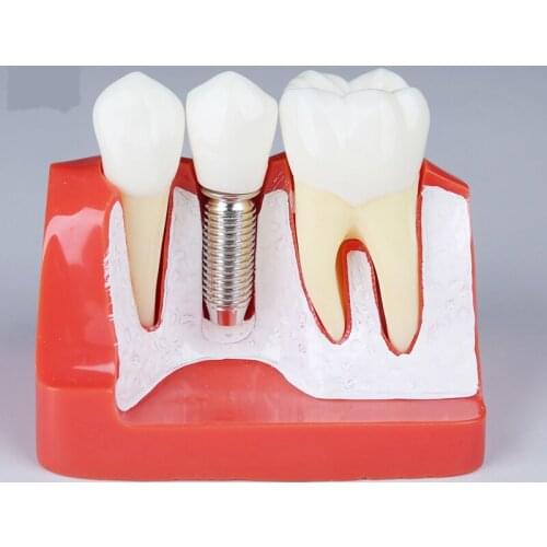 Dental Implant analysis teeth Model for Dental Clinic/Dental Implant Training teeth Model M2017R/Dentist use Implant tooth Model