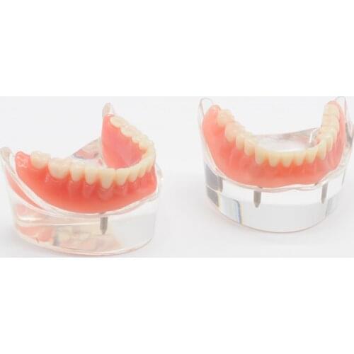 Dentist Lower Mandibular With 2/4 Implants Restoration Teach Model