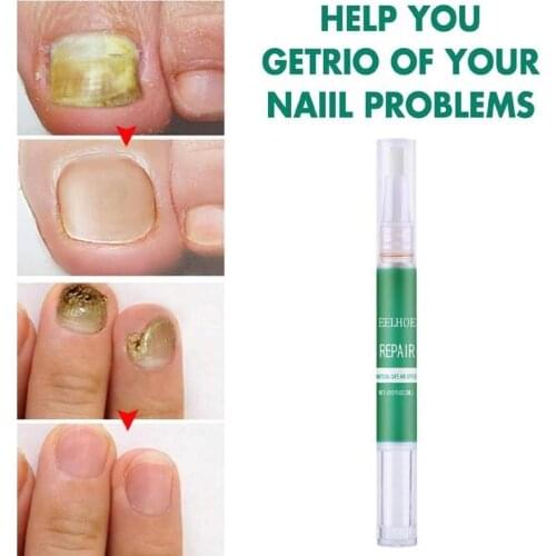 3ml Nail Repair Care Pen Anti-fungal Treatment Set Nail Treatment Pen Onychomycosis Paronychia Anti Fungal Fungus Care Repair