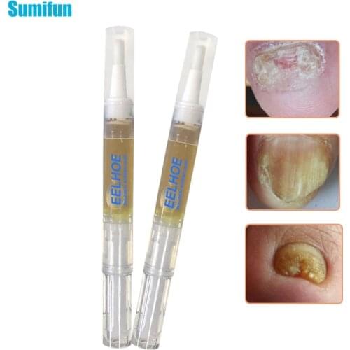 1/2pcs Anti-Fungal Liquid Toenail Infection Nail Pen Onychomycosis Paronychia Chinese Herbal Toe Fungus Care Repair Skin Care