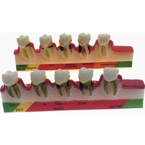 Dentist Odontologia Periodontal Disease Dental Teeth Model Tooth dental Model 5 Stage