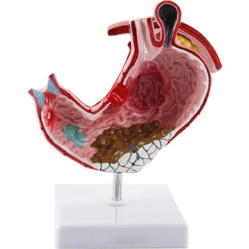 Human Anatomical Stomach Model Medical Anatomy Model Gastric Pathology Gastritis Ulcer Medical Teaching Learning Tool