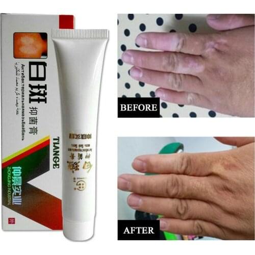 Medical White Spot Disease Cream Pigment Melanin Promoting Liniment Skin Vitiligo Leukoplakia Disease Treatment plaster