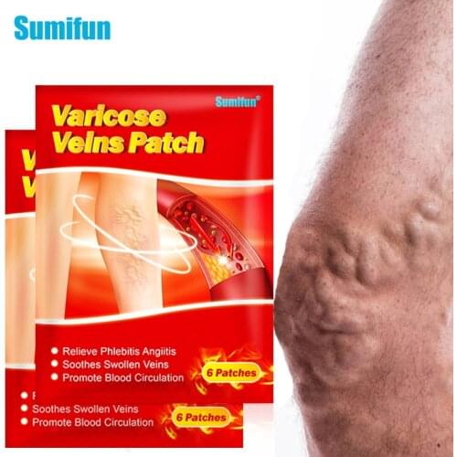 Sumifun 6/12Pcs Varicose Veins Plaster Spider Leg Vasculitis Phlebitis Care Treatment Angiitis Removal Patch Chinese Medical